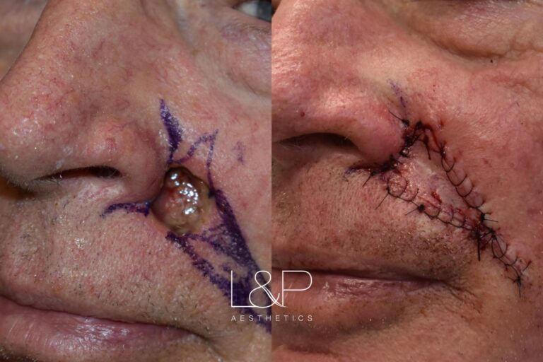 Reconstructive Surgery before and after treatment