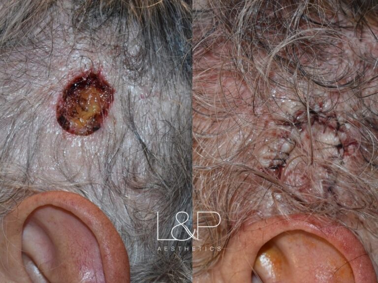 Reconstructive Surgery before and after treatment