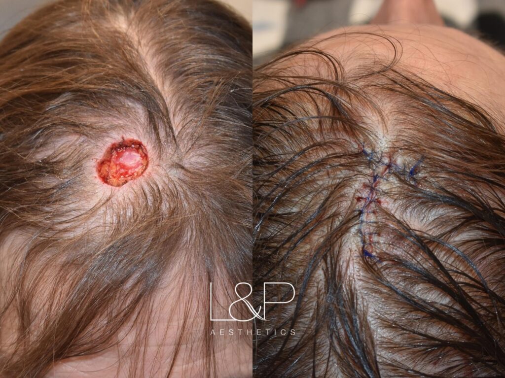 Reconstructive Surgery before and after treatment