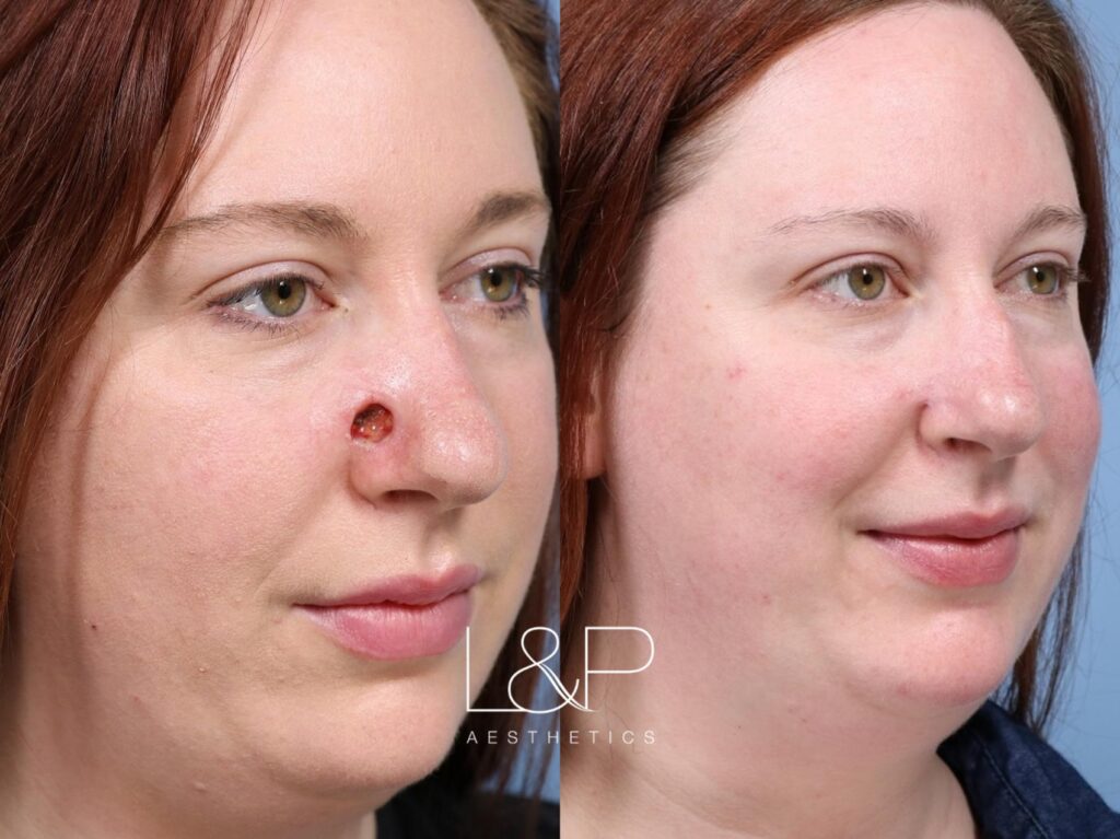 Reconstructive Surgery before and after treatment