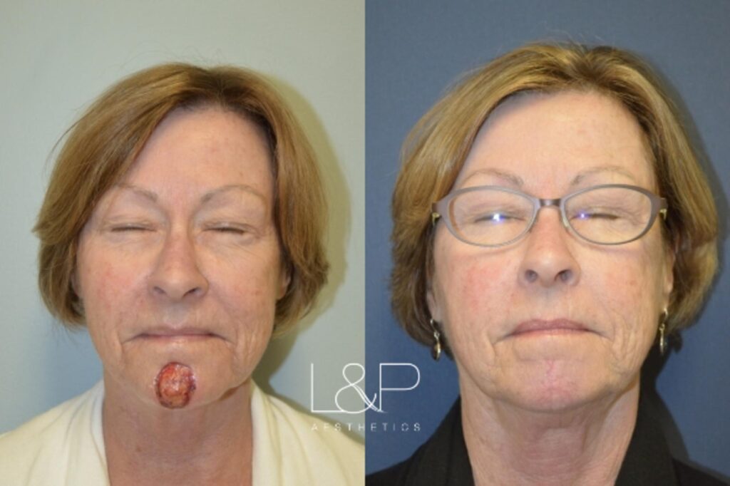 Reconstructive Surgery before and after treatment