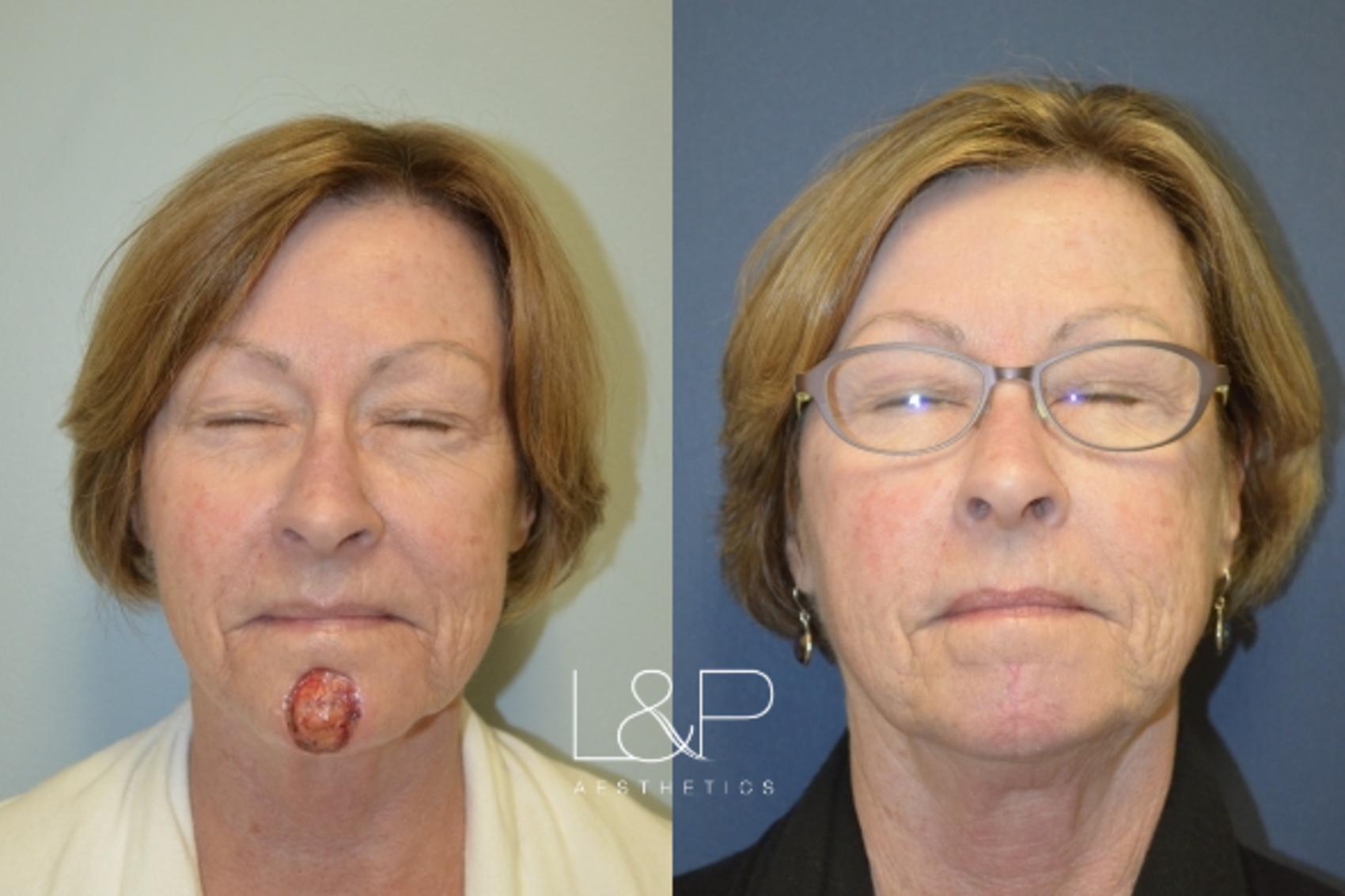 Reconstructive Surgery before and after treatment