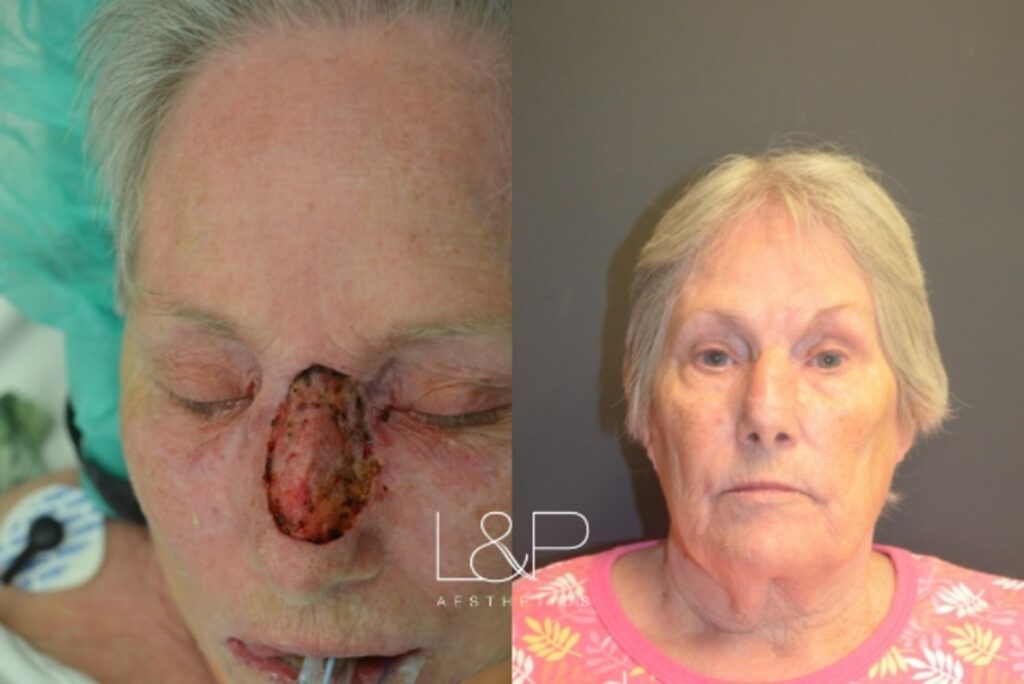 Reconstructive Surgery before and after treatment