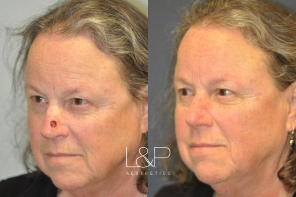 Reconstructive Surgery before and after treatment