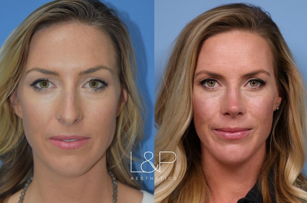 Rhinoplasty before and after treatment in Los Gatos, California
