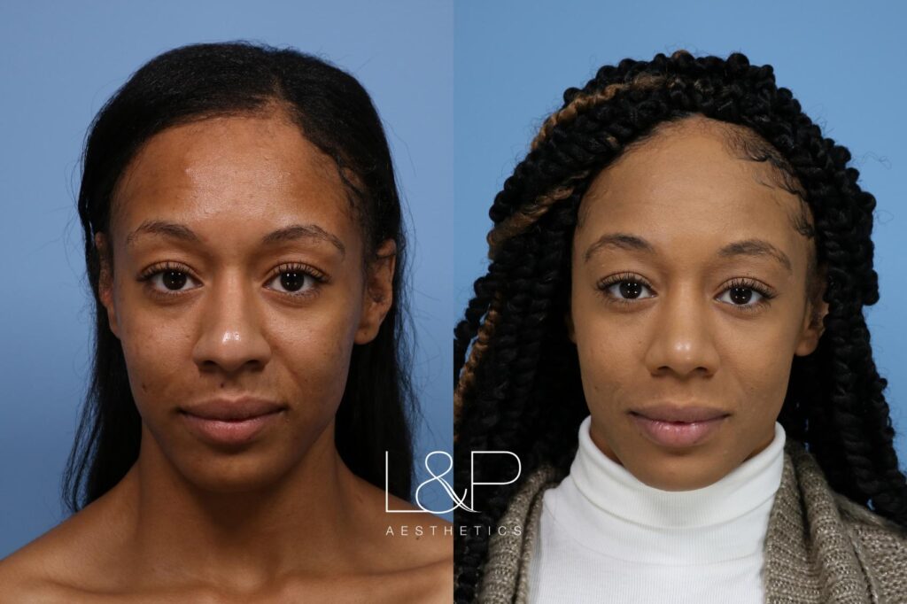 Rhinoplasty female patient before and after treatment in the Bay Area