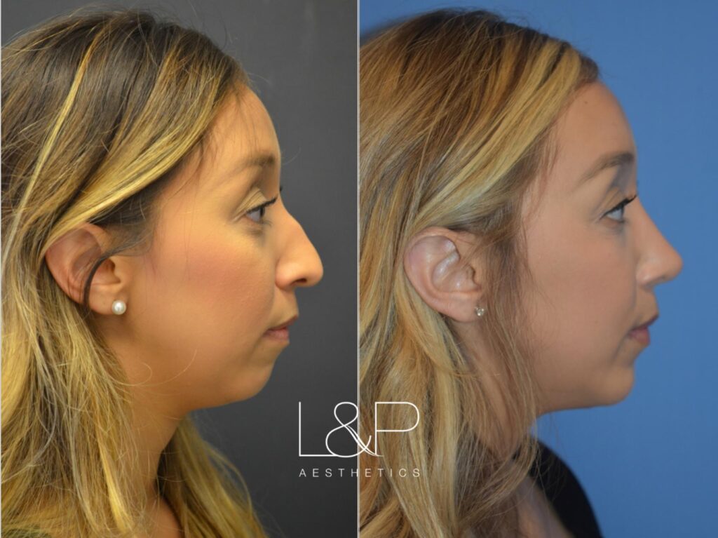 Rhinoplasty before and after treatment in California