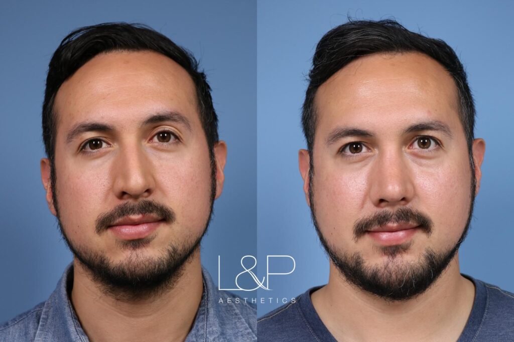 Rhinoplasty and chin augmentation before and after treatment in California