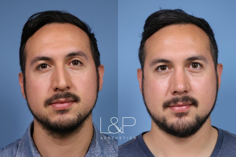 Rhinoplasty and chin augmentation before and after treatment in California