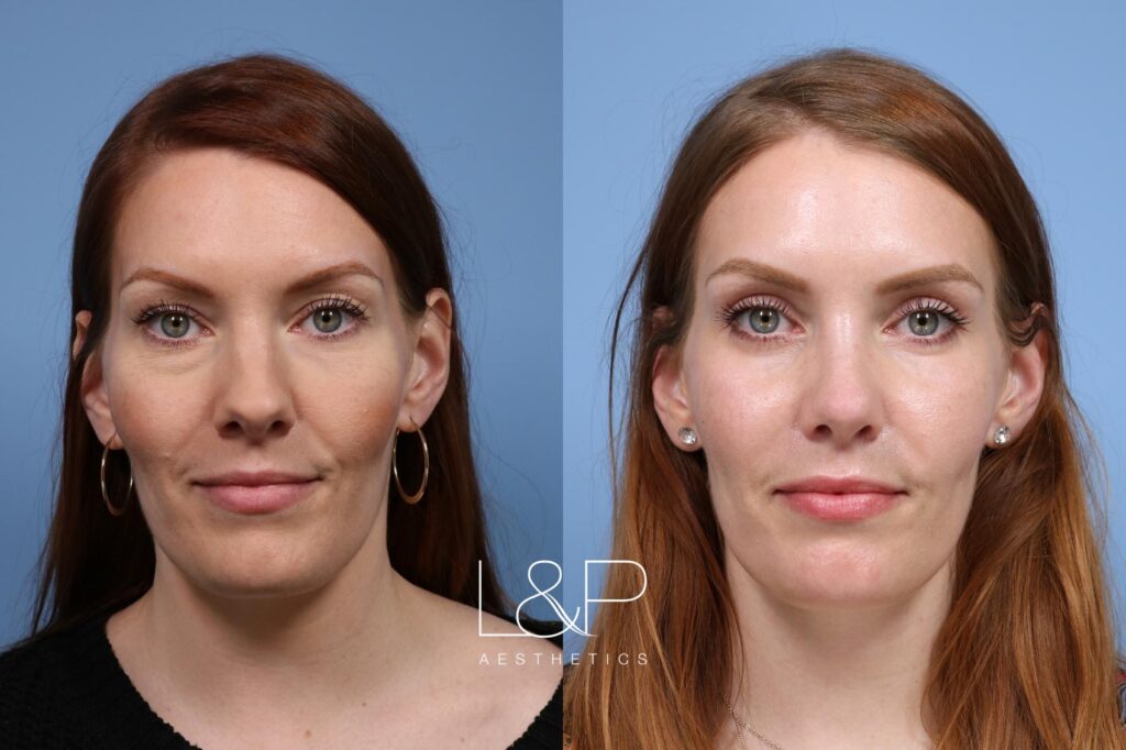 Rhinoplasty, blepharoplasty, and laser resurfacing female patient before and after treatment in the Bay Area at L&P Aesthetics