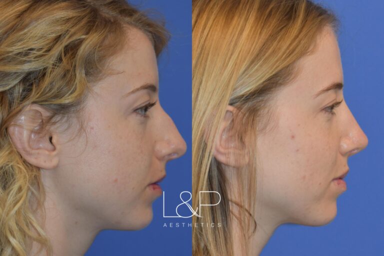 Rhinoplasty before and after treatment in Palo Alto, California