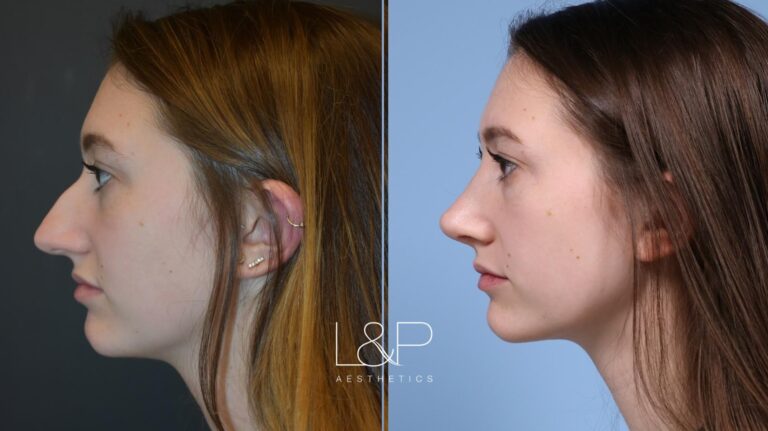 Rhinoplasty before and after treatment in Los Gatos, California