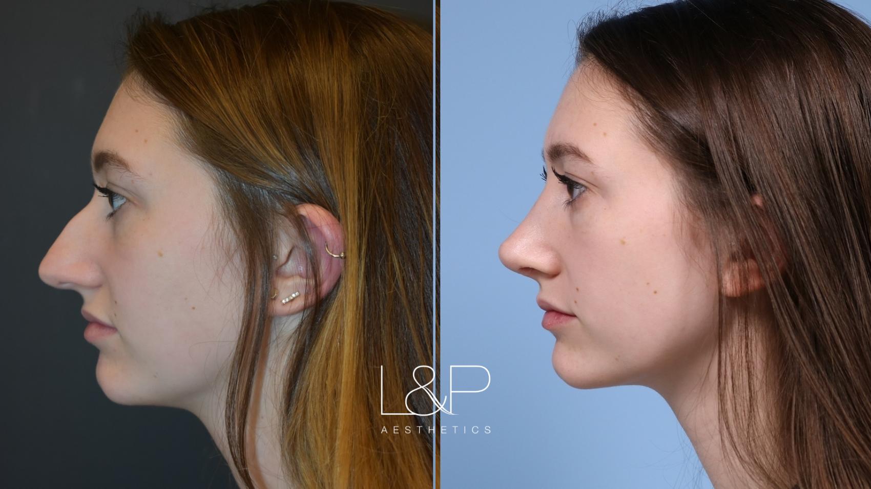Rhinoplasty before and after treatment in Los Gatos, California