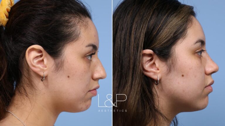 Rhinoplasty before and after treatment in Los Gatos, CA