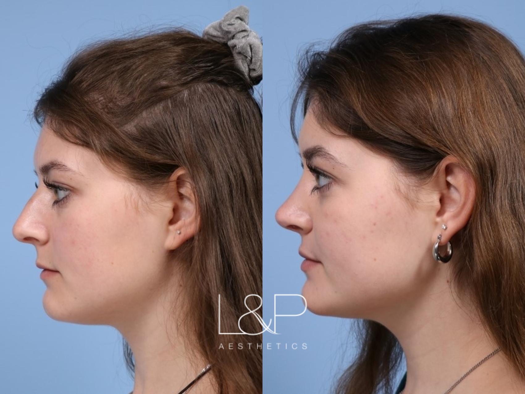 Rhinoplasty before and after treatment in CA