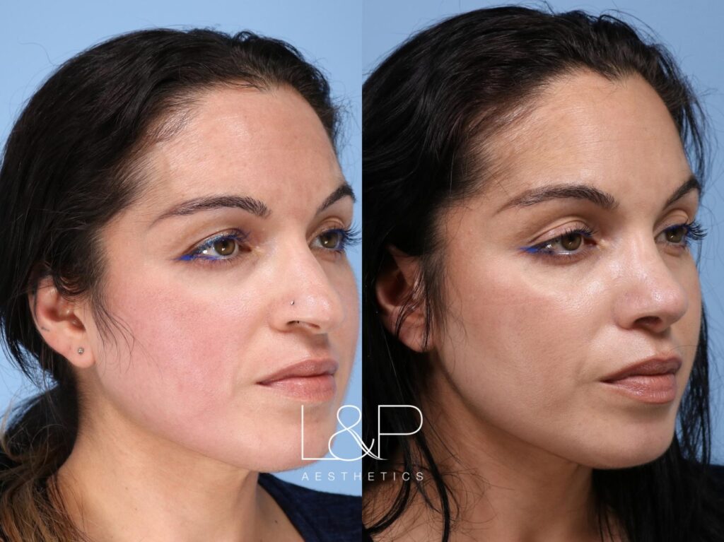 Rhinoplasty before and after treatment in Palo Alto, California