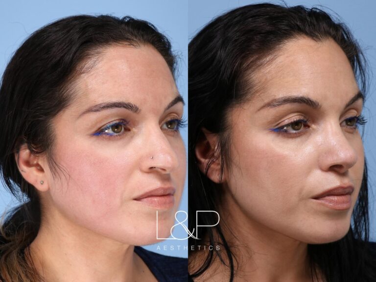Rhinoplasty before and after treatment in Palo Alto, California