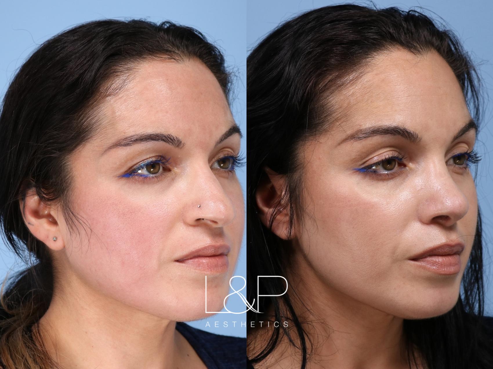 Rhinoplasty before and after treatment in Palo Alto, California