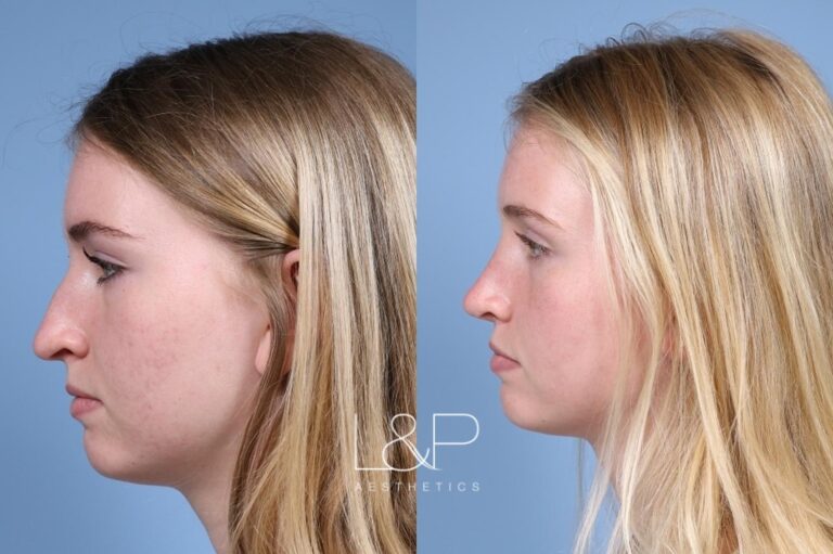 Rhinoplasty before and after treatment in Palo Alto, CA