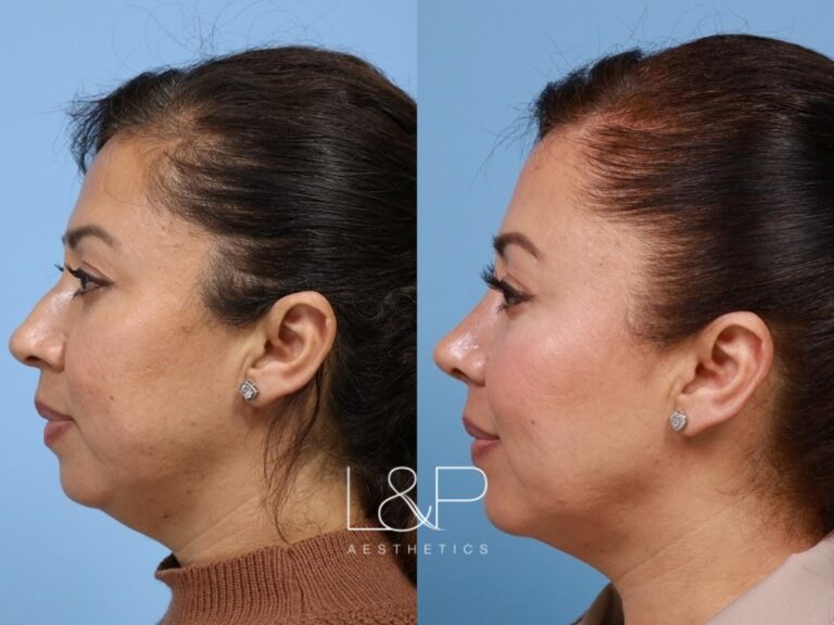 Rhinoplasty before and after treatment in Palo Alto, CA