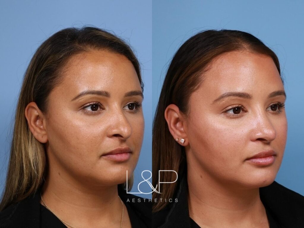 Rhinoplasty before and after treatment in California