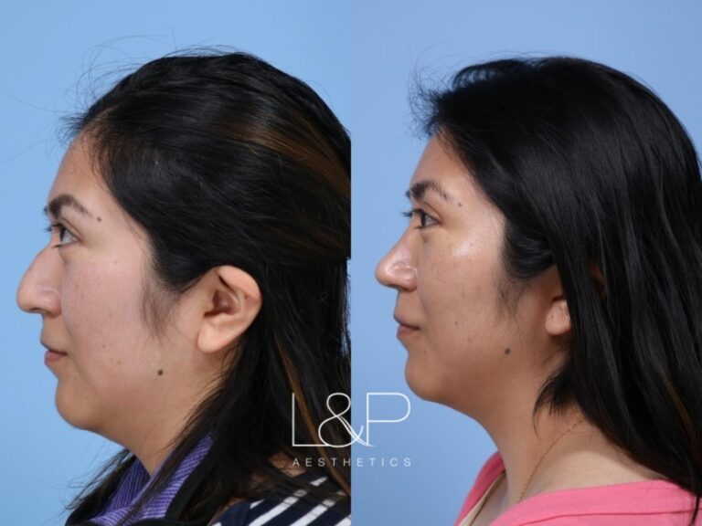 Rhinoplasty before and after treatment in Palo Alto, California