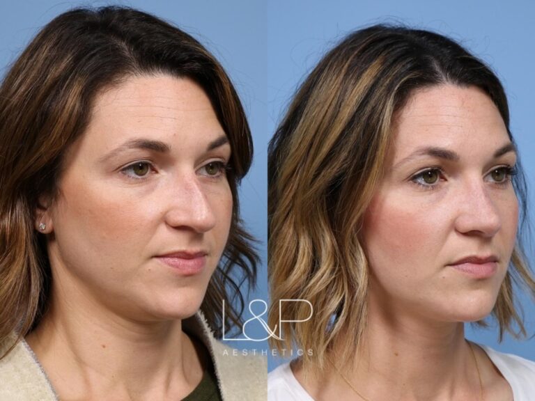 Rhinoplasty before and after treatment in the Bay Area