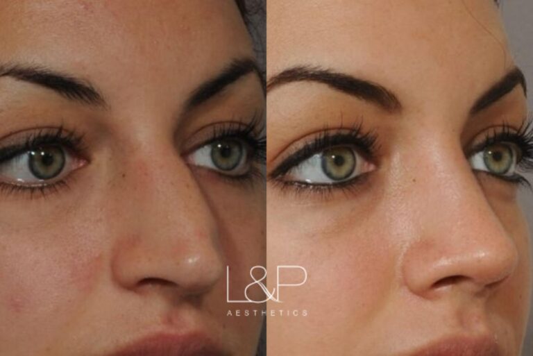 Rhinoplasty before and after treatment in Palo Alto, CA