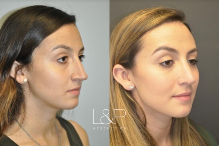 Rhinoplasty before and after treatment in the Bay Area