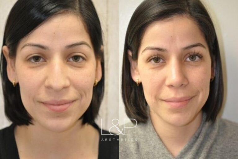 Rhinoplasty before and after treatment in CA