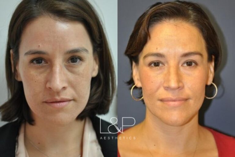 Rhinoplasty before and after treatment in Los Gatos, CA