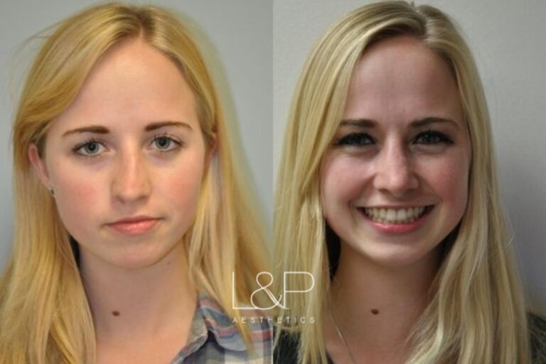 Female Rhinoplasty patient before and after treatment in California