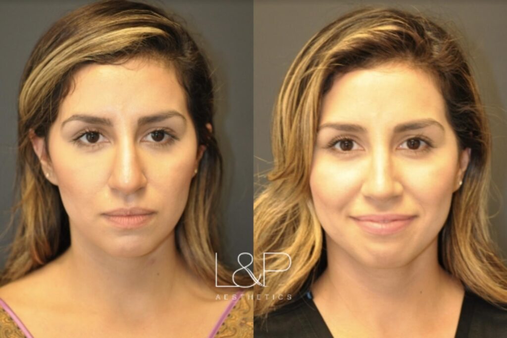 Woman Rhinoplasty Patient before and after treatment in Bay Area