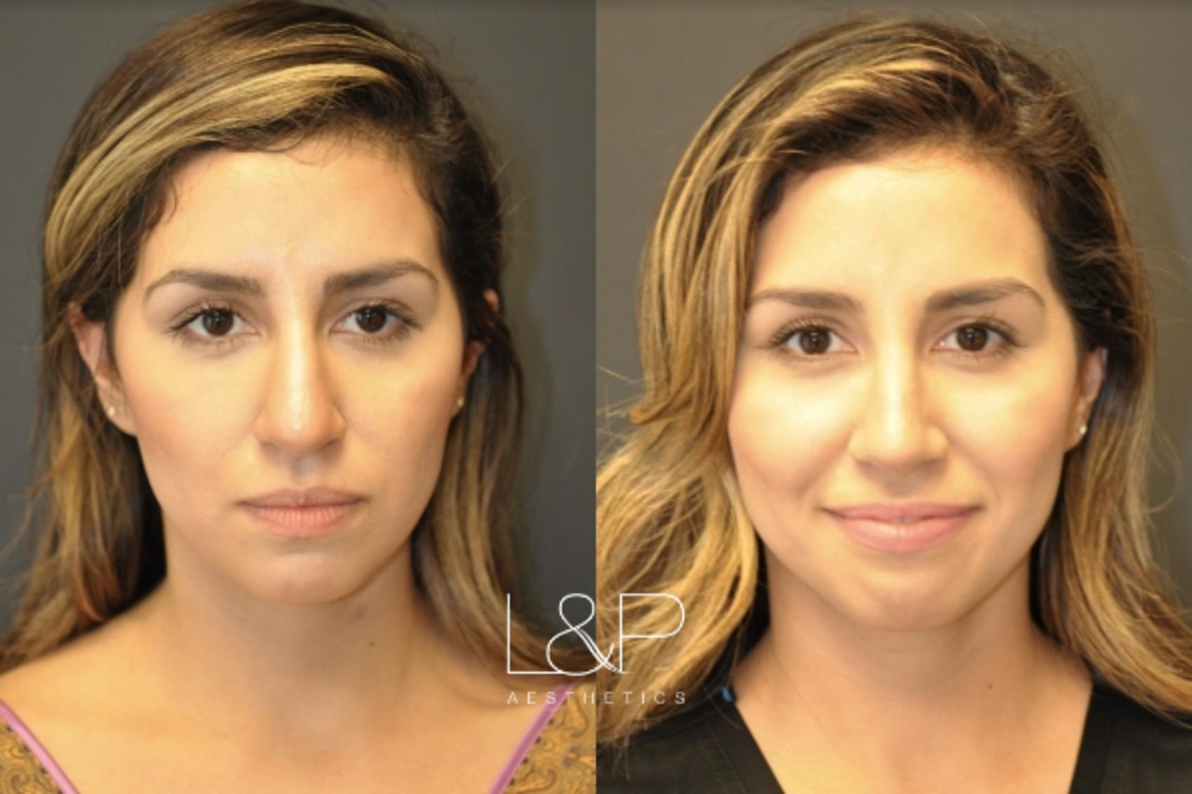 Woman Rhinoplasty Patient before and after treatment in Bay Area