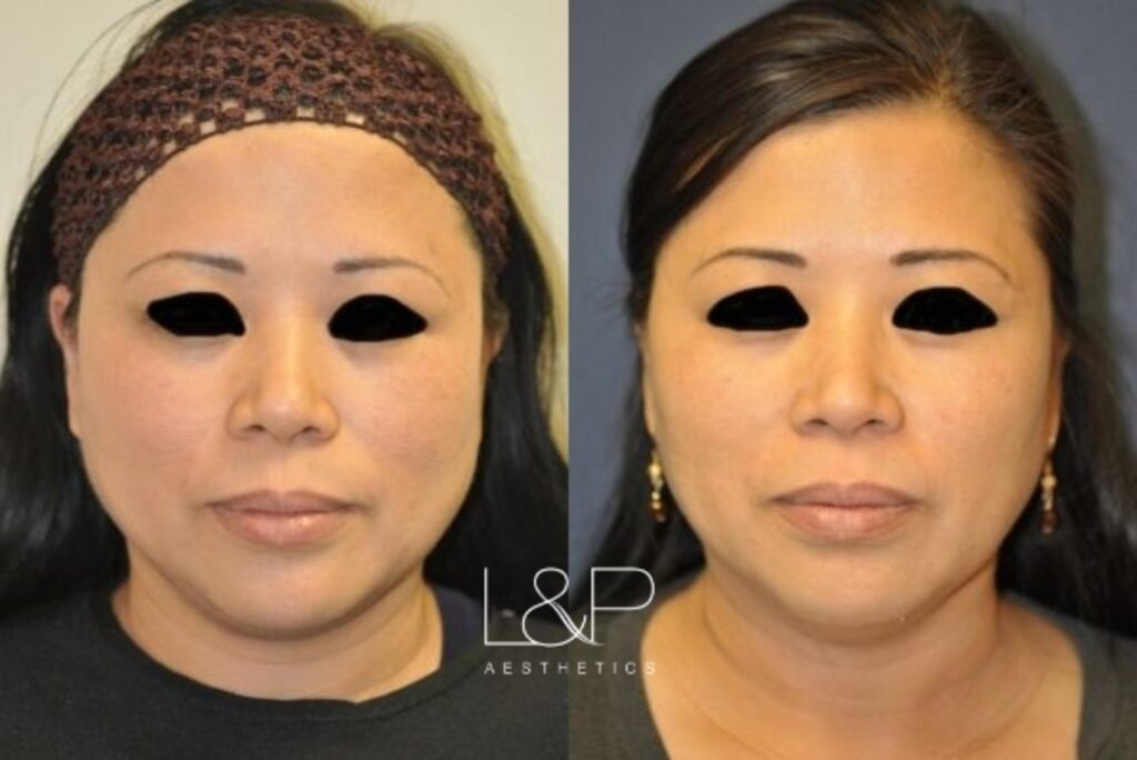 Ultherapy before and after treatment