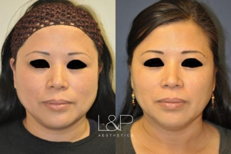 Ultherapy before and after treatment