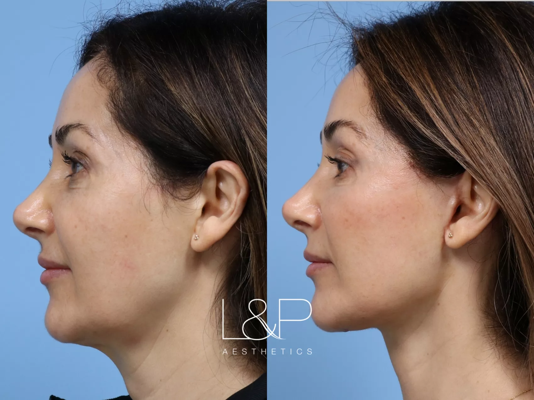 Facelift Neck Lift before and after treatment - Palo Alto Mini Face and Neck Lift