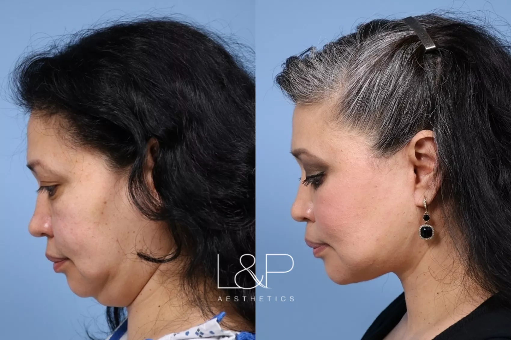 Facelift Neck Lift before and after treatment - Facelift Palo Alto