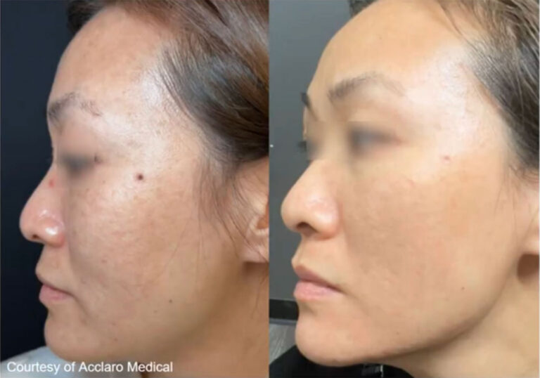 Acne Scar Removal with UltraClear - UltraClear Laser Before and After in California