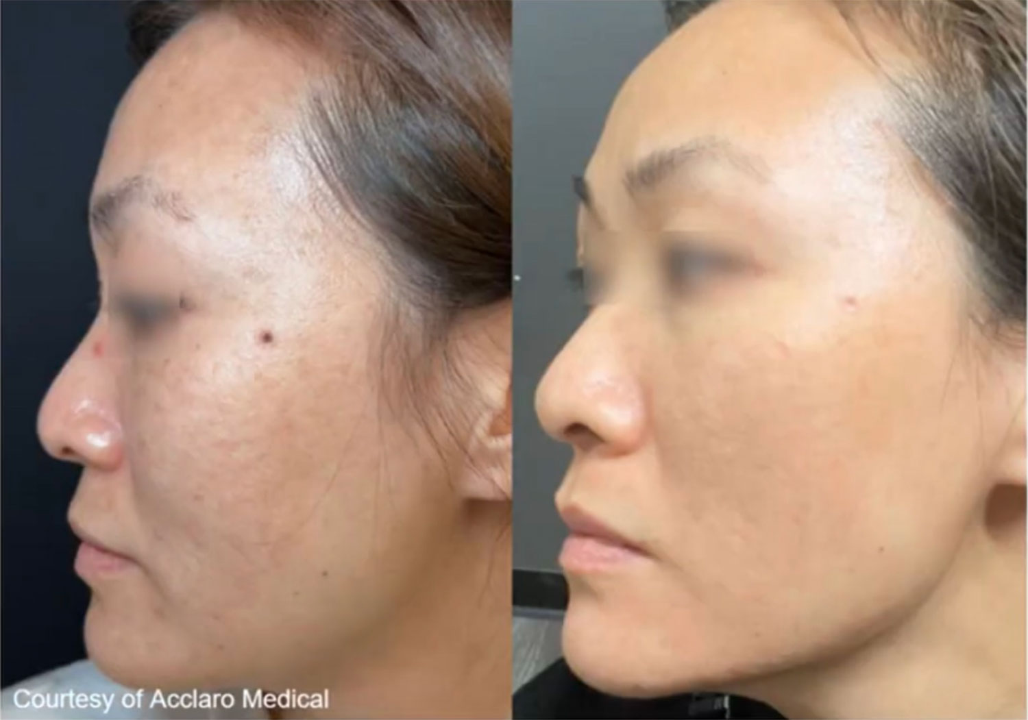 Acne Scar Removal with UltraClear - UltraClear Laser Before and After in California