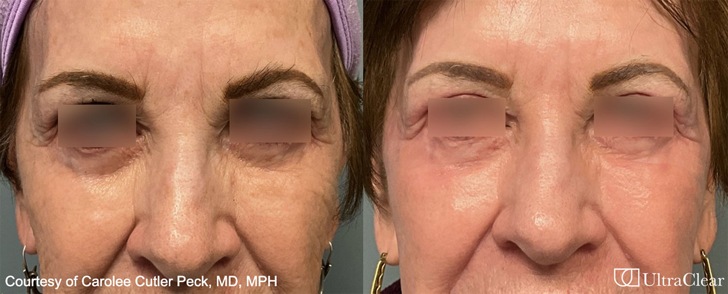 UltraClear Laser Before and After Results in Los Gatos, CA