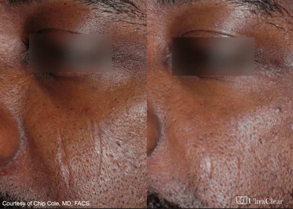 Scar Removal with UltraClear - UltraClear Laser Before and After in California