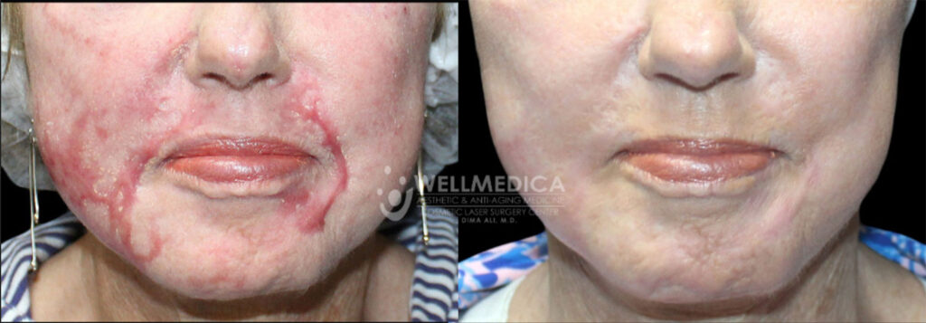 Scar Removal with UltraClear - UltraClear Laser Before and After in Palo Alto, CA