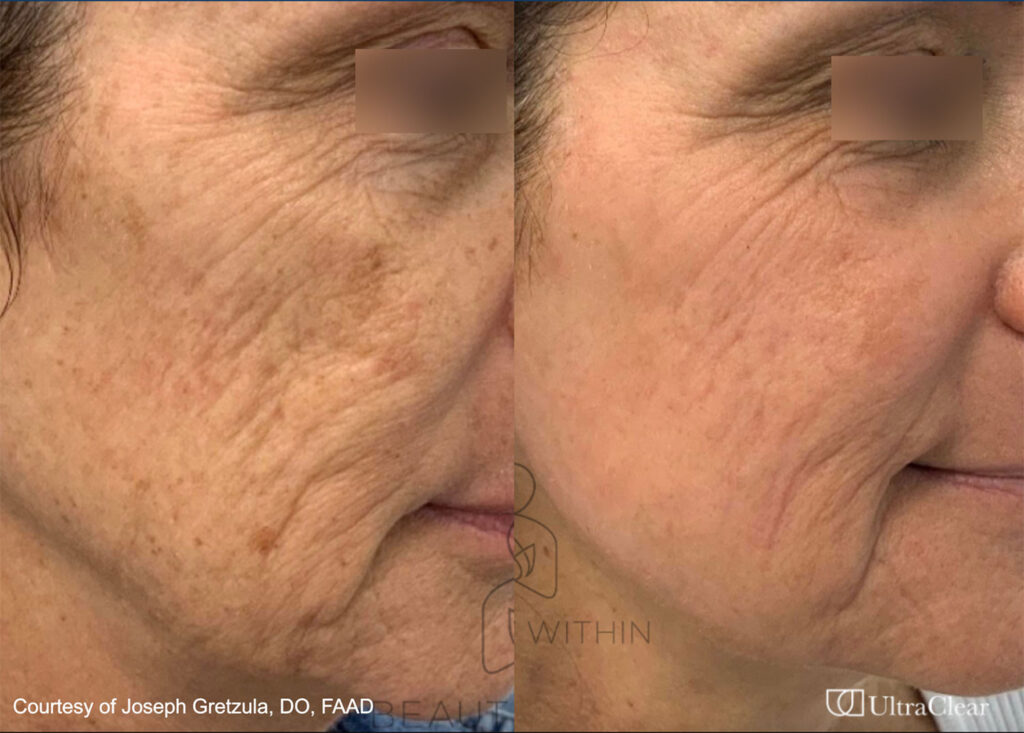 UltraClear Laser Before and After in California