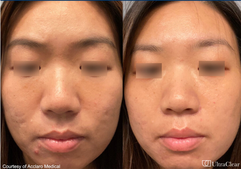 UltraClear Laser Before and After in Los Gatos, CA