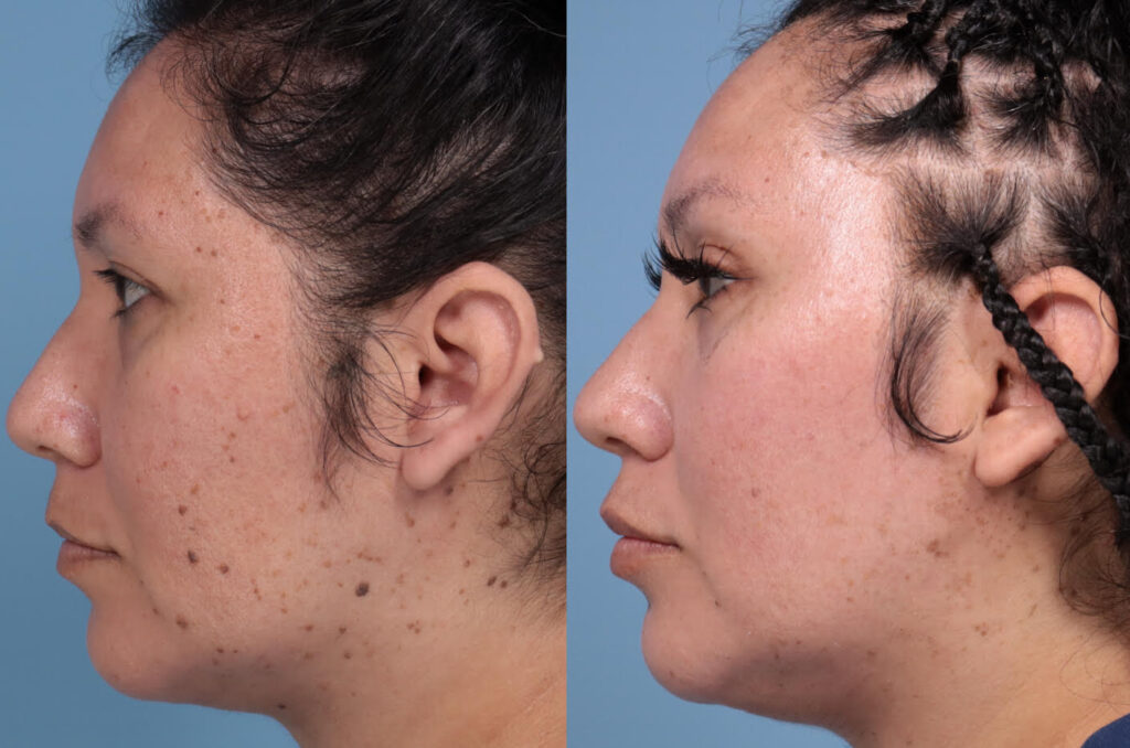 TRL and UltraClear Laser Before and After in Palo Alto, CA