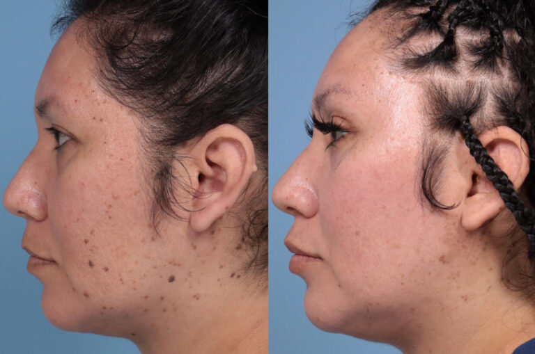TRL and UltraClear Laser Before and After in Palo Alto, CA