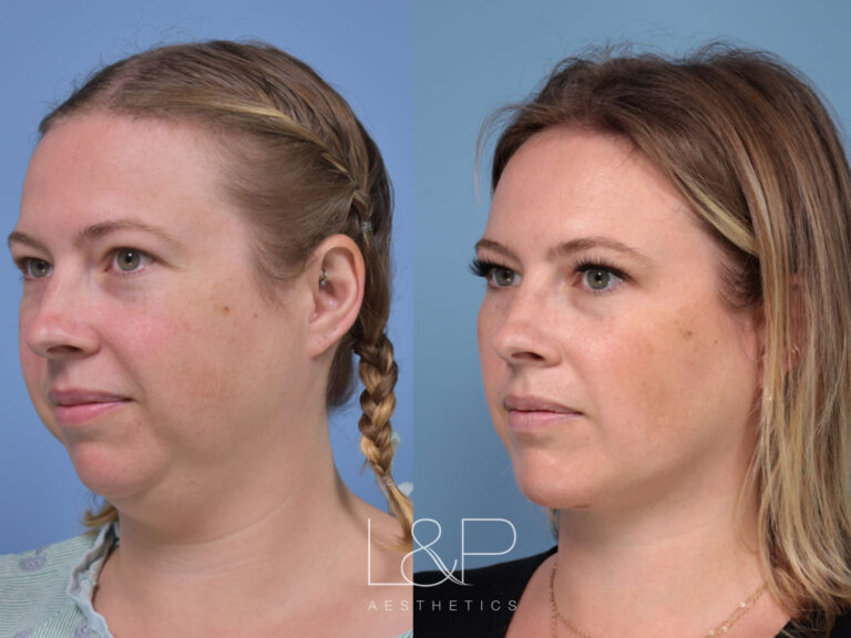 Female Chin Augmentation at 36-1