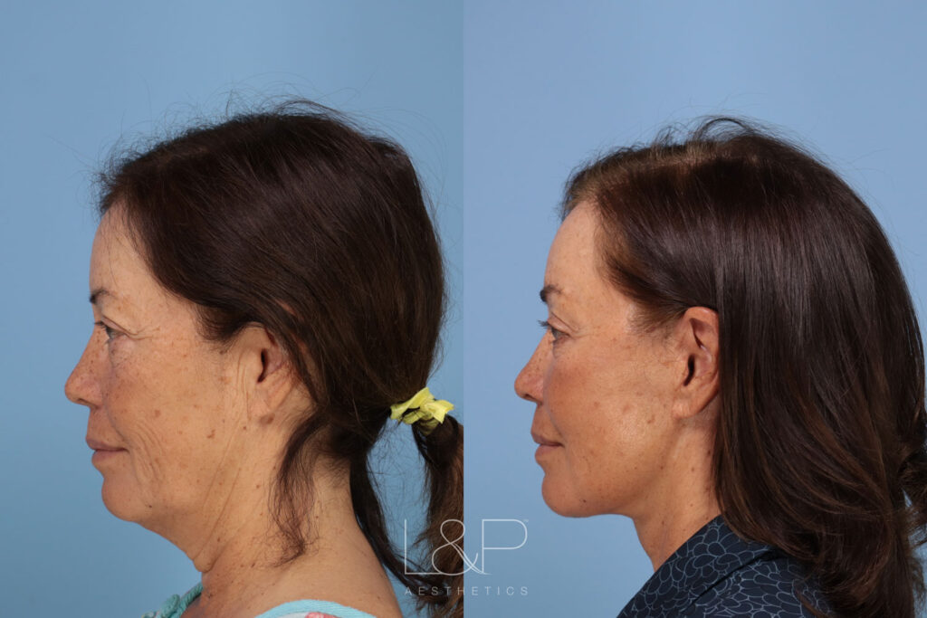 Before and after of a mini facelift & L&P Aesthetics