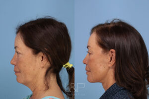 Before and after of a mini facelift & L&P Aesthetics